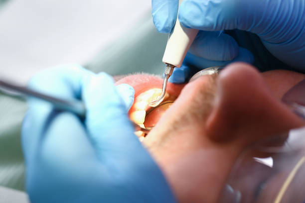 Best Emergency Root Canal Treatment in Winchester, OH